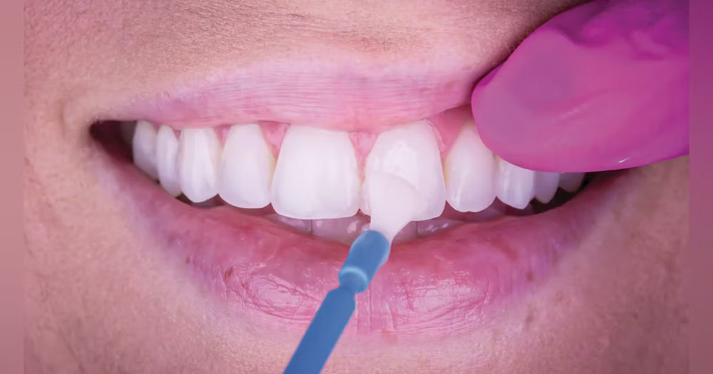 The Remarkable Benefits of Fluoride Varnish in Preventative Dental Care